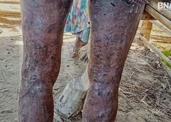 (ဓာတ်ပုံ - ကျန်းမာရေးစောင့်ရှောက်မှုတွေလိုအပ်နေတဲ့မောင်တောမြို့နယ်ကမြိုစစ်ဘေးရှောင်တဦး / BNA)