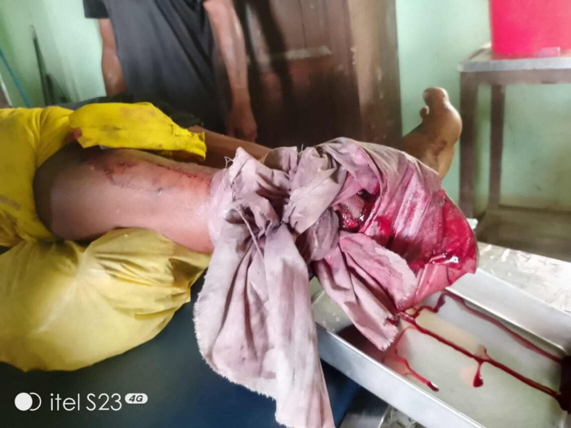 (ဓာတ်ပုံ - မောင်တောမြို့နယ်မှမြေမြုပ်မိုင်းနင်းမိလို့ခြေထောက်ပြတ်သွားသူ / ပေးပို့)