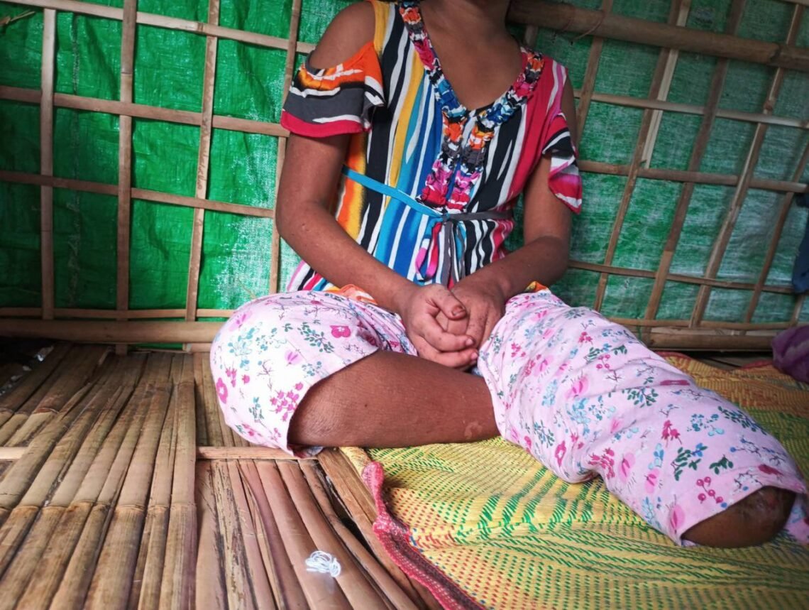 (ဓာတ်ပုံ - မြေမြုပ်မိုင်းနင်းမိလို့ ခြေထောက်တဖက်ပြတ်သွားတဲ့ မိန်းကလေးငယ်ဟာ ခြေတုတပ်ဖို့လိုအပ်နေပါတယ် / BNA)